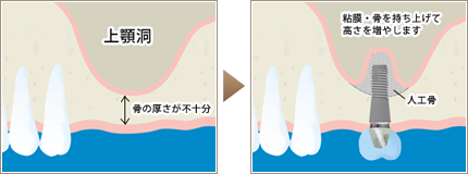 サイナスリフト