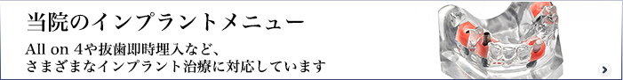 当院のインプラントメニュー