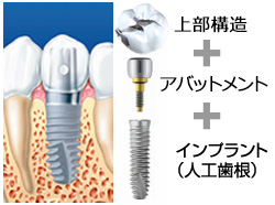 インプラントの基本構造